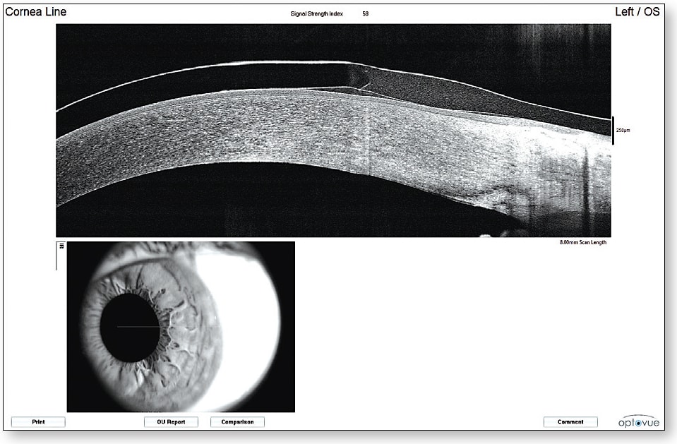 Figure 3. Anterior segment OCT of a normal cornea design hybrid lens. The lens is built to fit on flat K plus 0.50D. This appears on OCT as a lens that is fit flat on the cornea and differs from vaulting lenses that are intended to create a measurable post-lens tear reservoir. Note the lens junction that creates edge lift at the periphery of the GP portion of the lens to promote tear exchange.