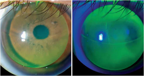 Figure 2. Translating GP viewed with white light and cobalt blue filter. The lens shows a slight lid-attached alignment fitting, with the segment line slightly encroaching into the pupil. Mild temporal decentration is tolerated in a translating design. However, this patient complained of fluctuating vision and monocular diplopia with the blink. The segment height was lowered on adjustment.