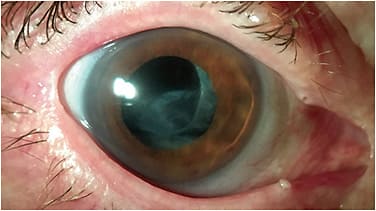 Figure 7. Bandage soft contact lens on a neurotrophic cornea to prevent corneal desiccation. Loss of corneal sensation and blink function occurred after removal of an intracranial trigeminal schwannoma. Note the permanent lateral tarsorrhaphy and punctal occlusion.