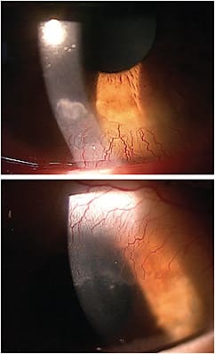 Figure 1. Hypoxia from scleral lens wear can result in neovascularization and corneal edema.