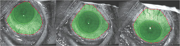 Figure 1. A set of up, straight, and down gazes taken with a corneoscleral topographer.