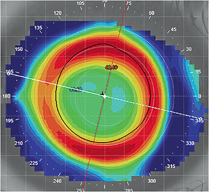 Figure 1. An orthokeratology power ring that is mostly outside of the pupil.