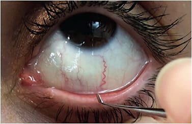 Figure 1. Debriding the lower lid margin with a blunt-ended surgical spud.