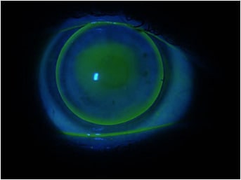 Figure 2. Similar fluorescein pattern OS with a good tear distribution.