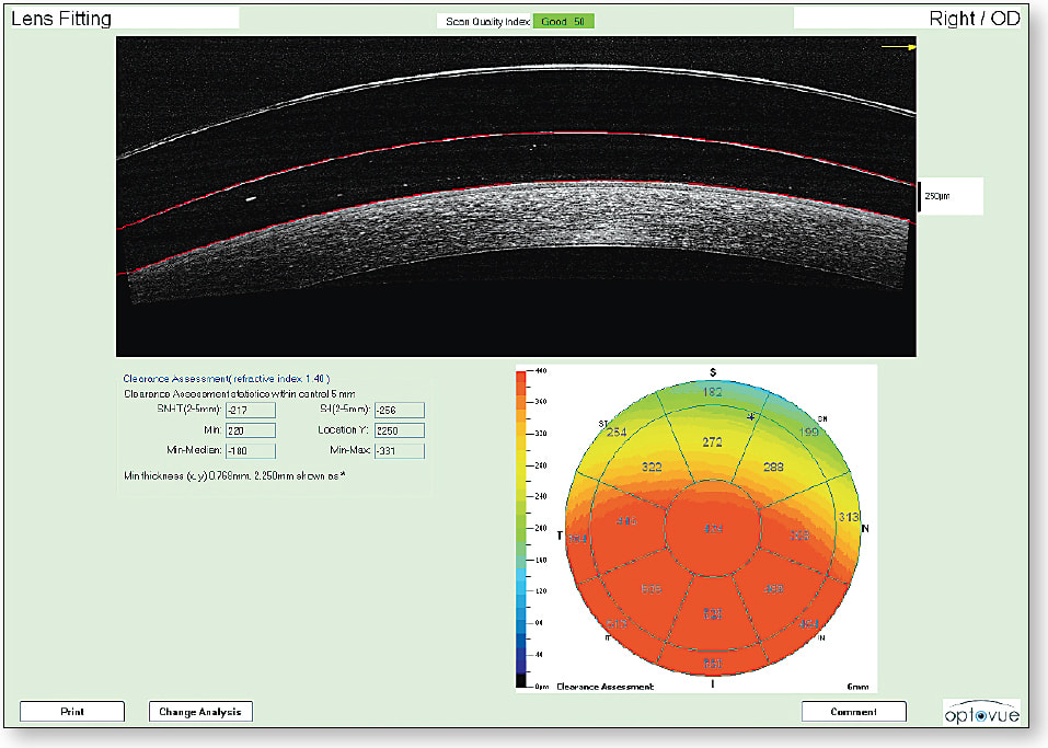 Figure 10. AS-OCT demonstrating automated vaulting software display.