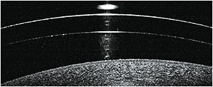 Figure 1. Vertical cross section of a scleral lens decentered inferiorly. The superior region (right side of scan) shows less lens clearance compared to the inferior region (left side).