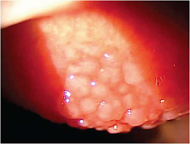 Figure 3. Patient presenting with giant papillary conjunctivitis secondary to contact lens abuse.