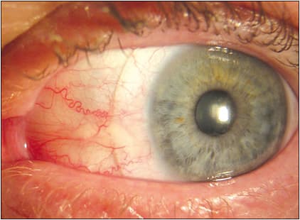 Figure 3. Scleral lens with an edge lift that vaults the pinguecula.