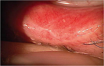 Figure 3. Cicatrizing (scarring) of the palpebral conjunctiva in ocular cicatricial pemphigoid is an indication that scleral lens wear may be warranted to protect the cornea from advancing disease.