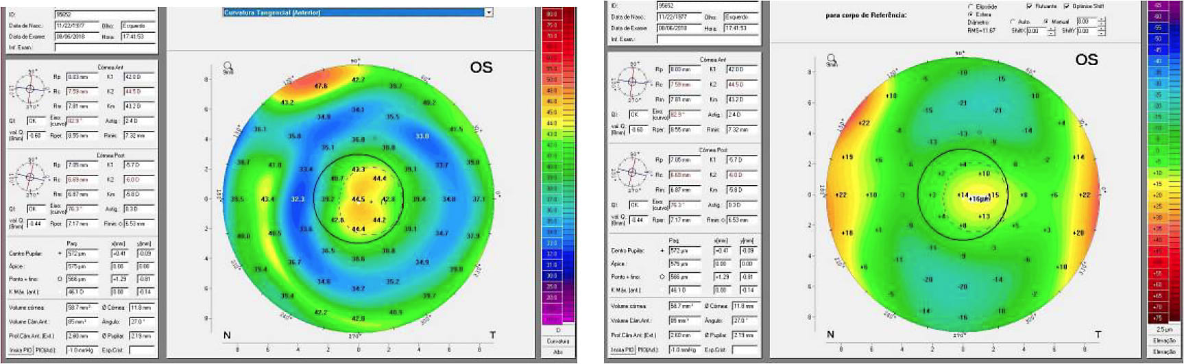 Figures 11 and 12. OS anterior tangential curvature and anterior elevation maps.