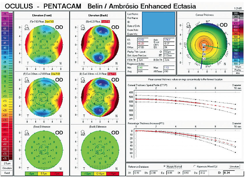 Figure 2. Belin/Ambrosio display illustrating no signs of keratoconus.