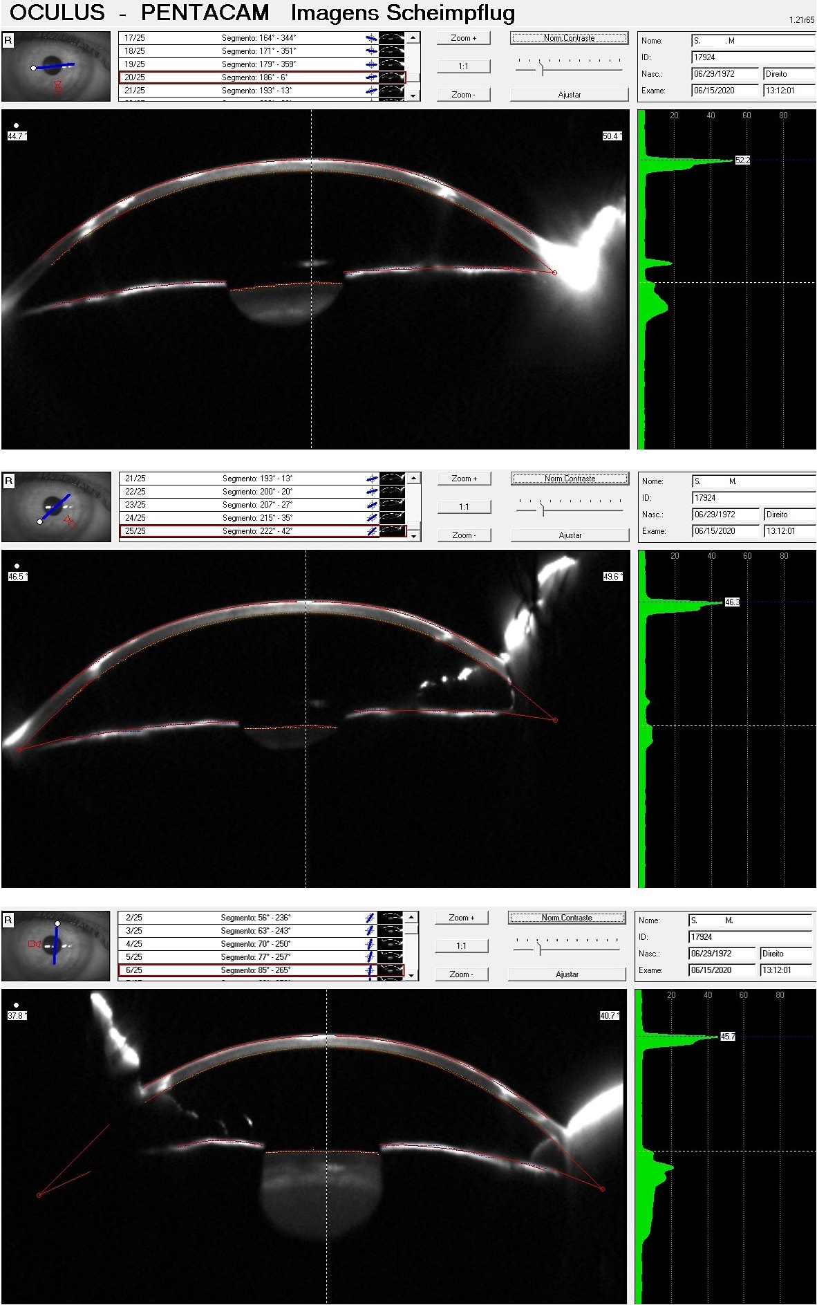 Figures 3, 4, and 5. Scheimpflug images showing the different angles.