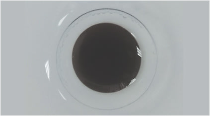 Figure 1. Custom high-powered contact lenses can be designed to help children who have congenital ocular conditions causing pathological myopia and photosensitivity.
