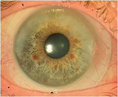 Figure 2. Scleral lens successfully fitting a patient with SND. Image courtesy of Gregory W. DeNaeyer, OD.