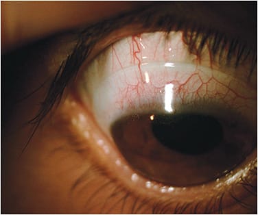 Figure 6. A tight-fitting lens causing compression and impingement of the vessels and conjunctiva.