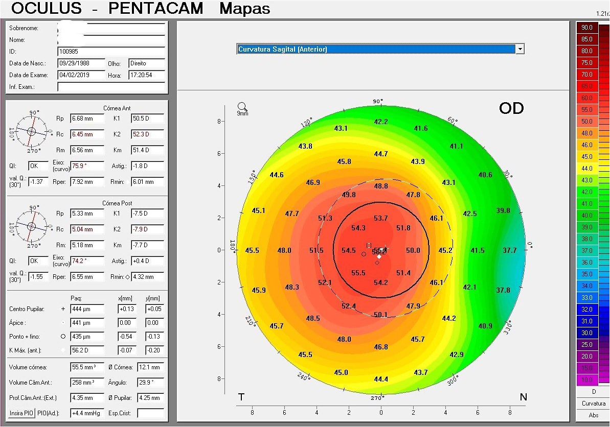 Figure 3. Topography map showing moderate keratoconus OD.