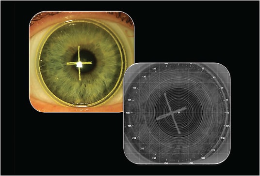 Figure 3. Corneal topography technique to measure the amount of offset required. The yellow cross represents the geometric center of the lens, and the small white cross represents the line of sight.