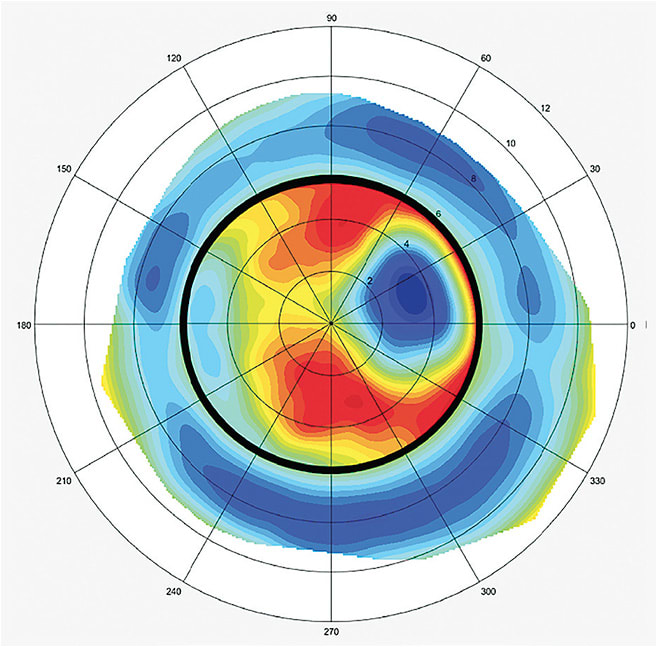 Figure 6. A corneoscleral elevation map. The black circle represents the limbus.