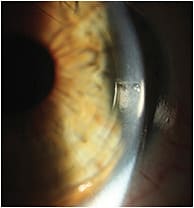 Figure 7 Case 4 lens OS demonstrating toric lens marking at 3 o’clock.