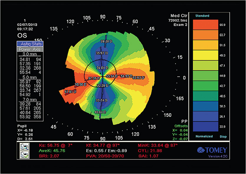 Figure 2. In July 2013, the topography of Patient #1’s graft showed a jump to nearly 22.00D of cylinder.