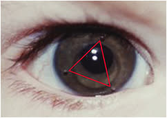 Figure 1. Scleral lens with three fenestrations in a triangle shape. Photos courtesy of Drs. Daddi Fadel and Don Ezekiel