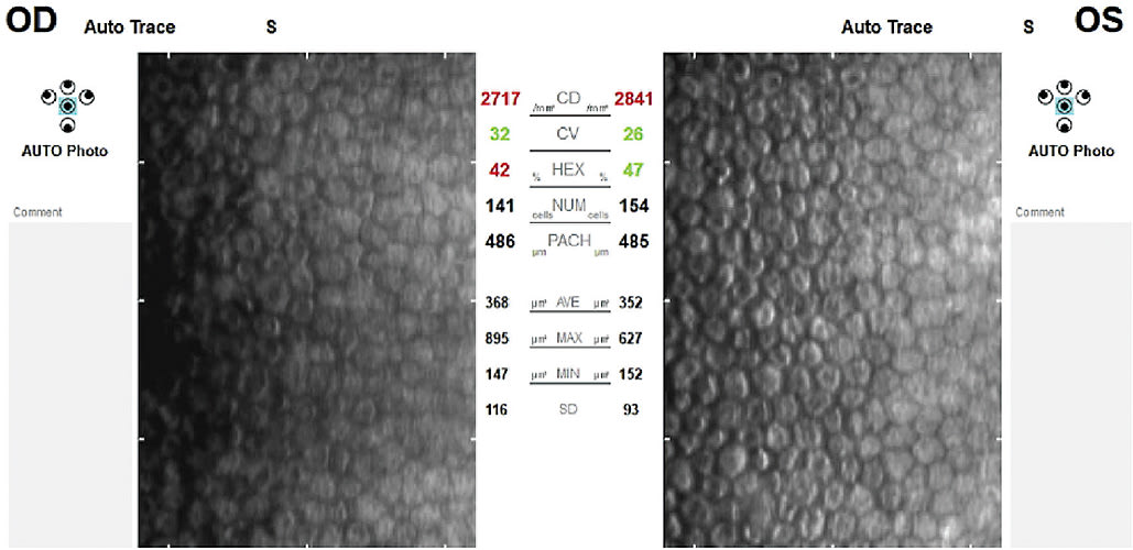 Figure 1. Healthy corneal endothelium.