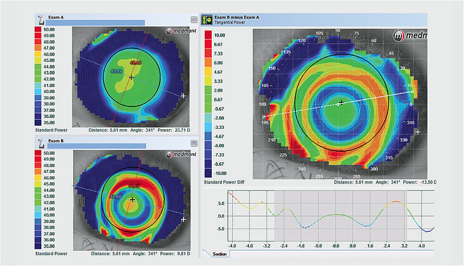 Figure 4. A frowny face topographical response appears as a red ring that decenters inferiorly with respect to the pupil.