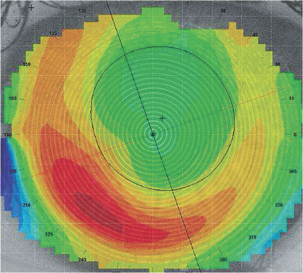 Figure 2. Corneal topography, axial power map of a post-LASIK cornea, OS, 40.7/41.6 @ 019.