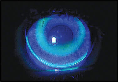 Figure 9. Slightly superior-positioning orthokeratology device under open eye conditions.