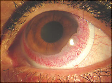 Figure 1. Scleral lens compression.