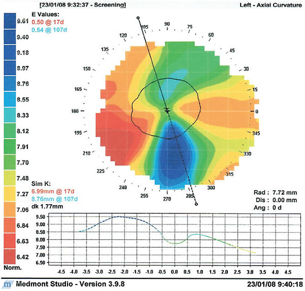 Figure 1. Corneal topography of Patient #1 in January 2008. The sim k curvatures translate to 48.25D and 38.50D or 9.75D of anterior corneal astigmatism. This is nearly identical to his refractive cylinder of 10.00D.