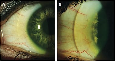 Figure 3. The edge profile of the same scleral lens with the light source directed (A) from the left, showing no compression and (B) from the right, casting a shadow on the conjunctiva due to the edge lift.