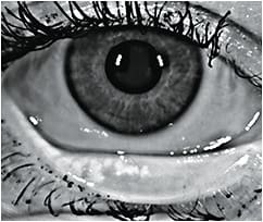 Figure 1. Assess meibomian gland dropout when troubleshooting GP lens deposits.