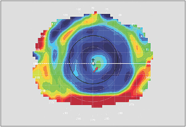 Figure 2. Tangential power difference map, OS, showing temporally displaced center-near multifocal optics. Black plus sign=pupil center; white plus sign=center of topography map; red arrow=position of the central lens optics.