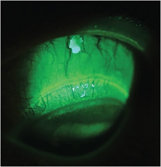 Figure 10. Limbal microcysts noted immediately after lens removal. The patient was wearing a 14.3mm diameter, &#x2013;8.25D, &#x2B;2.50D add multifocal scleral lens with a midperipheral thickness of 0.45mm and a limbal clearance of 20 microns. Conjunctival impingement staining is also present.&#xD;&#xA;Image courtesy of Steve Byrnes, OD.