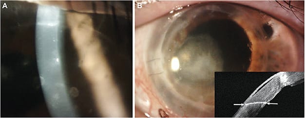 Figure 2. Scleral lens in disease. (A) A patient who underwent a lamellar keratoplasty presented with subepithelial infiltrates, edema, and hyperemia after initiating scleral lens wear. The patient was diagnosed with acute transplant rejection, treated with steroids, and was able to resume part-time lens wear with a high-Dk scleral lens fit with a low fluid reservoir depth. (B) A patient who underwent penetrating keratoplasty two years ago shows a distinct demarcation between host and donor tissue, with two sutures remaining temporally. This patient developed an ulcer in the donor tissue. Inset picture: OCT illustrates the inability of host and donor tissues to completely heal at the interface (white arrows).
Photos courtesy of (A) Dr. Maria Walker and (B) Dr. Christina Kinate.