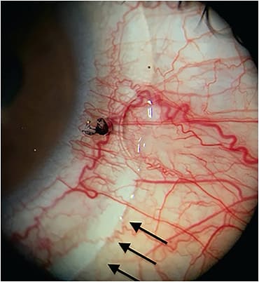 Figure 5. Photo taken immediately after the notch was made and the lens placed on the eye. Note the semi-blanching that is generated in the lower part of the lens. Image courtesy of Omar Sámano.