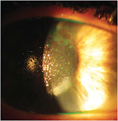 Figure 1. Poor surface wetting of the right scleral lens.