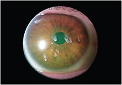 Figure 1. White deposits accumulate on the scleral lens surface.