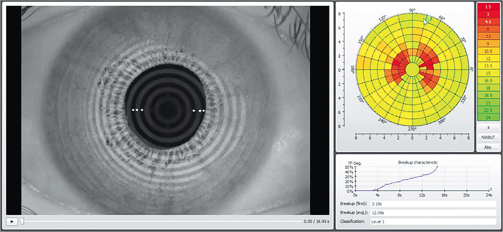 Figure 1. Non-invasive tear breakup analysis. This can be performed with and without the contact lens in place.