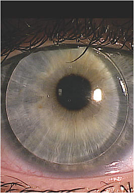 Figure 1. A well-centered GP fit piggybacked with a soft silicone hydrogel lens.