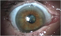 Figure 2. With scleral lenses, the patient was comfortable and able to resist forced closure.