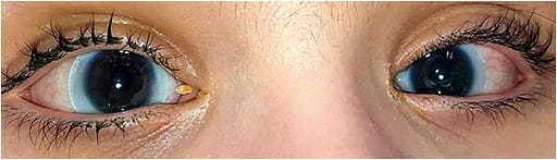 Figure 1. Corneo-scleral lenses corrected aphakia and prevented further mechanical injury to the cornea in this patient.