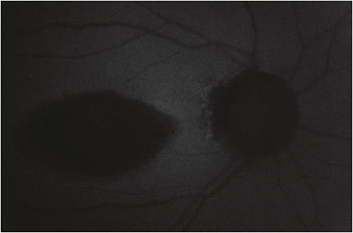 Figure 3. Cellular death demonstrated by autofluorescence.