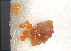 Figure 1. A homogenous gelatinous amorphous mucous plug excreted through the superior canaliculus following dilation and irrigation of the lower punctum.