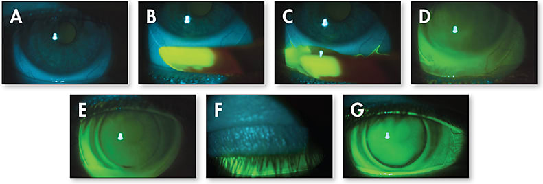 Figure 2. Time lapse photography of a patient wearing a Duette lens (SynergEyes). A moistened sodium fluorescein (NaFl) strip is applied to the outer border of the soft skirt. Images are taken every few seconds over the course of one minute. You can observe the NaFl flow under the lens.