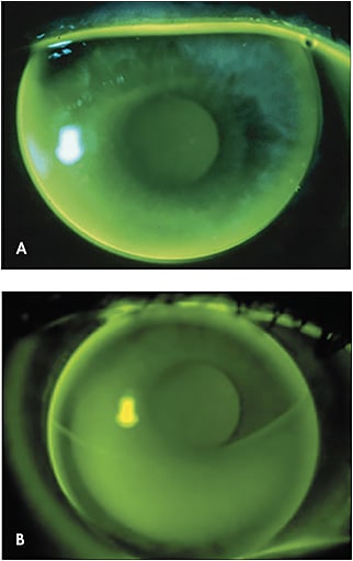 Figure 2. (A) An optimum-fitting aspheric GP lens. (B) An optimum-fitting segmented, translating lens.