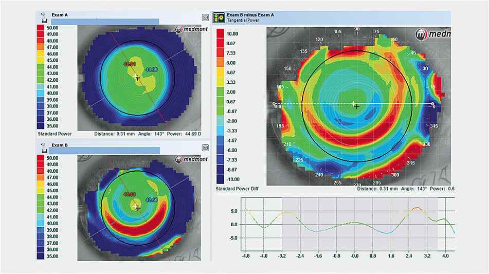 Figure 3. The smiley face topographical response appears as a red ring that decenters superiorly with respect to the pupil.