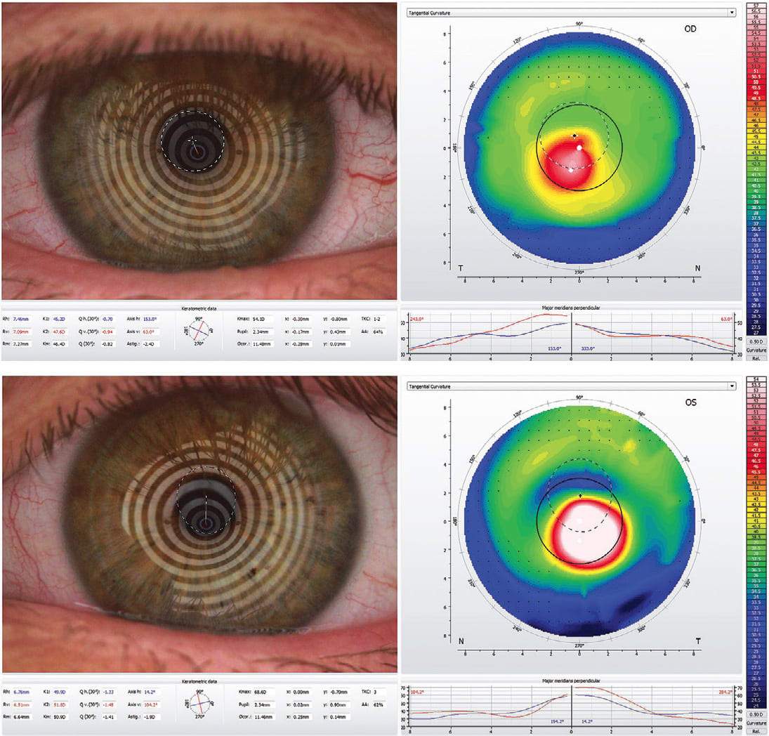 Figure 5. Corneal topography of Case 4 patient demonstrating keratoconus, OS &gt; OD.