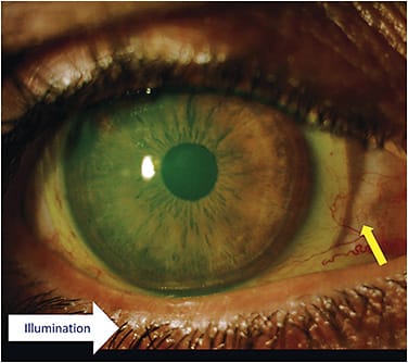 Figure 3. Identifying edge lift by a shadow. This patient reported nasal discomfort. The illumination of the beam was aimed nasally, and a significant shadow confirmed edge lift.